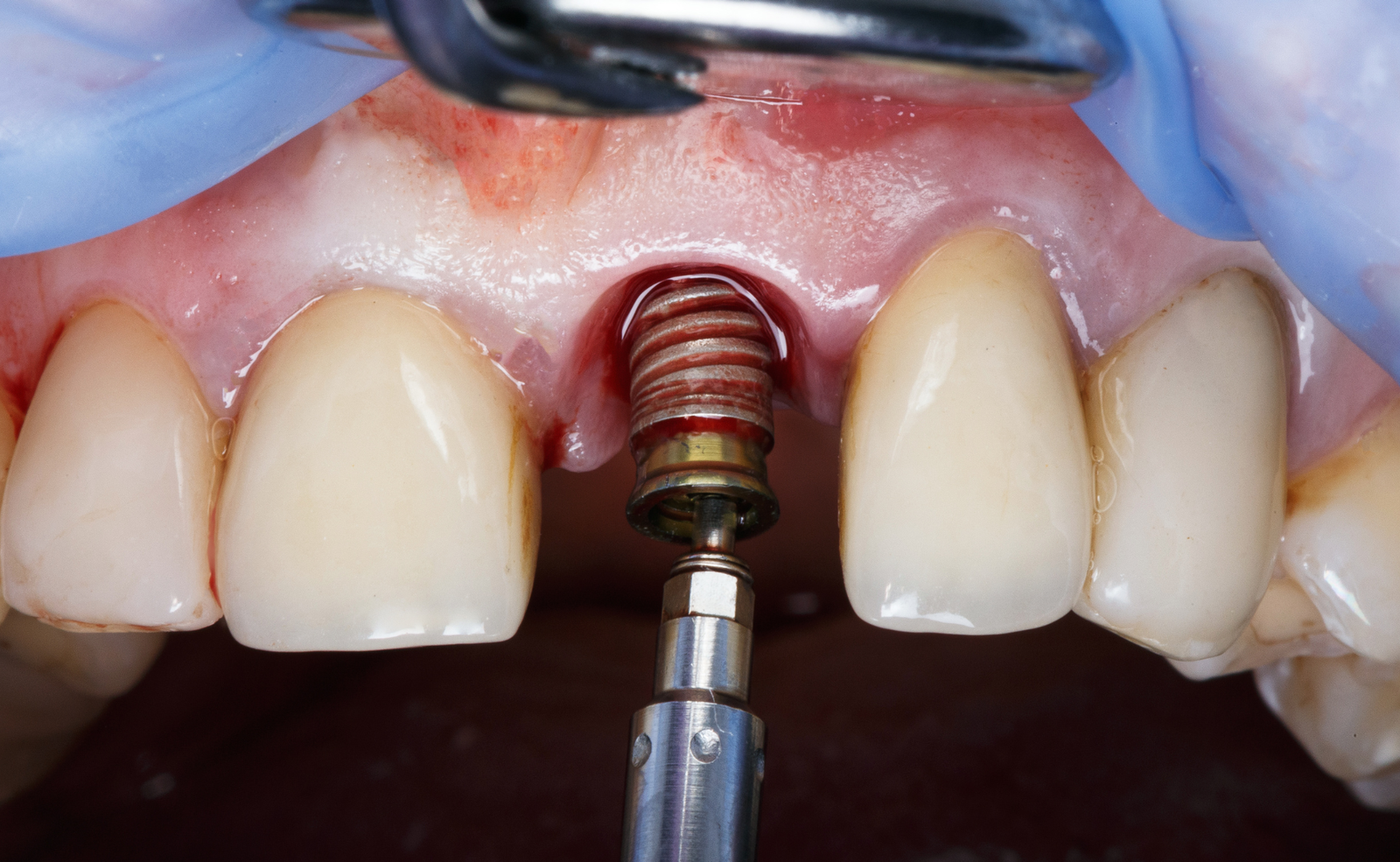 Imagen de colocación de un implante dejando al descubierto el tornillo